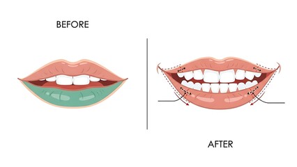 Flat Illustration Before and After Smiling Lips Cosmetic Surgery Procedure