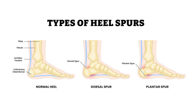 Different types of heel spurs types as feet bone disorder condition. Labeled normal, dorsal spur, plantar spur. Calcaneal bone condition. Medical education poster flat vector illustration.