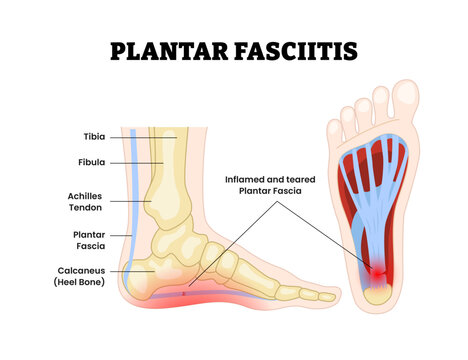 Plantar fasciitis as feet bone disorder condition. Heel bone, Inflammation Fascia muscle inflammation and tearing. Painful foot condition. Medical education poster flat vector illustration.