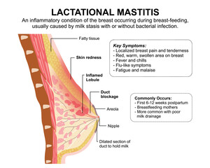 Lactational Mastitis Breast Illustration Medical Flashcard