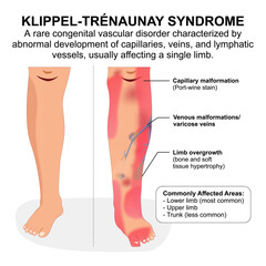 Klippel-Trenaunay Syndrome (KTS) Medical Flashcard