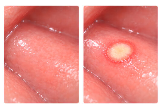 Photorealistic 3D clinical-style intraoral view of an aphthous ulcer on the inner lower lip, small shallow oval lesion with whitish center and mild red margin