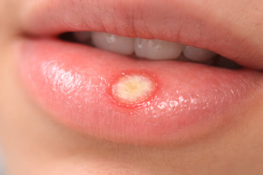 Photorealistic 3D clinical-style intraoral view of an aphthous ulcer on the inner lower lip, small shallow oval lesion with whitish center and mild red margin