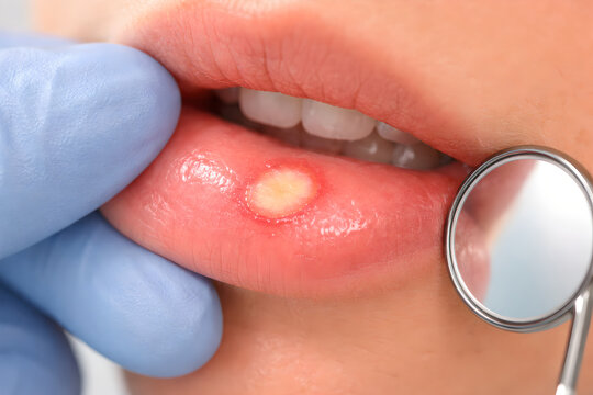 Photorealistic 3D clinical-style intraoral view of an aphthous ulcer on the inner lower lip, small shallow oval lesion with whitish center and mild red margin