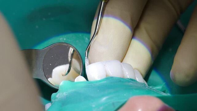 Dentist applying installing veneers. Doctor placing set of composite veneers on patient teeth. Dental care concept. Metal-ceramic crowns and bridges. closeup shot. Dentistry treatment, prosthetics of
