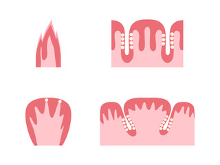 舌の乳頭のイラスト