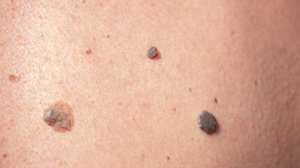 Nevus close-up. Mole on human skin. Irregular birthmark.