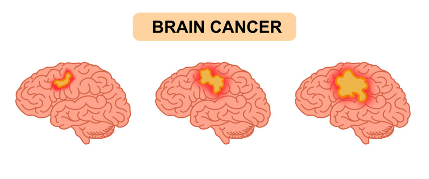 Brain tumor illustration. Human brain cancer, glioma, tumor in human brain tissue. Cancer cell structure. Vector illustration for medical, scientific, and educational purposes.