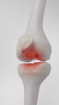Knee Joint Inflammation and Cartilage Degeneration Medical 3D animation