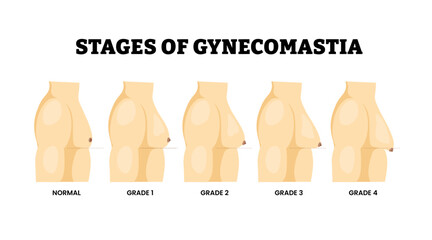 Stages of Gynecomastia stages. Male breast enlargement progression from normal size to fourth grade. Hormonal imbalance condition. Benign enlargement of breast tissue in males. Excess glandular size.