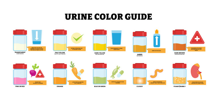 Different types of urine color guide types shows a hydration chart. Sample cups and color scale. transparent to dark brown and other hues for health cues. Medical vector illustration