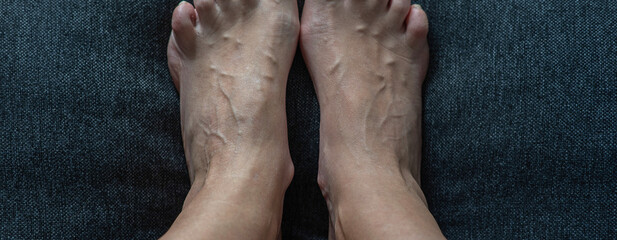 Tired legs with the veins on them .