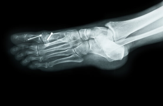 X-ray of the front foot after Hallux Valgus surgery sideview black background closeup