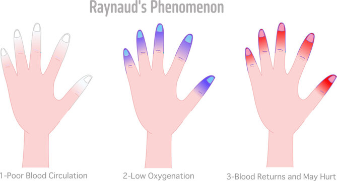 Raynaud's phenomenon disease steps. Resulting in areas turning white, blue or red. Cold hands syndrome. usually fingers and toes. Condition that causes blood vessels. Vector illustration