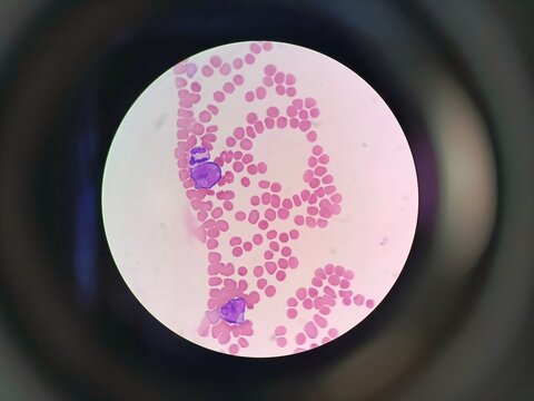 A microscopic view of blast cells alongside neutrophil in a human blood smear slide. 