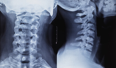 X-ray of a human neck spine. Inflammation and diseases cervical spine.