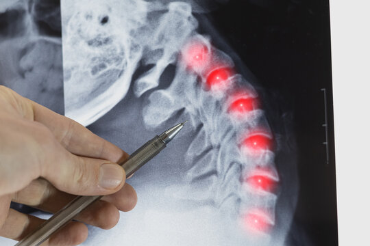 Doctor learn X-ray of a human bent neck spine. Inflammation and diseases cervical spine.