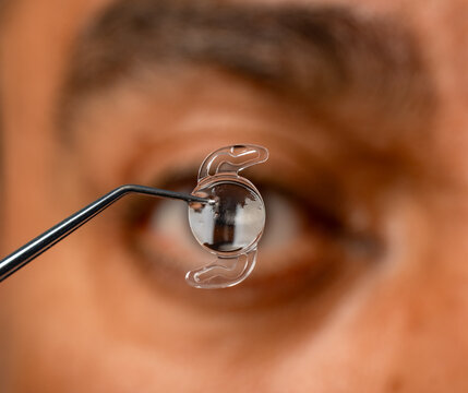 Foldable intraocular lens for cataract surgery held in eye
