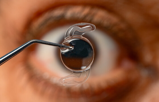 Foldable intraocular lens positioned before human eye in surgery