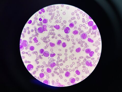 Leukemia blood smear moderate Immature cell.
