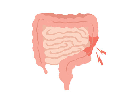 Irritable Bowel Syndrome IBS in Intestines Illustration
