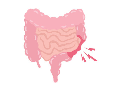 Hand Drawn Irritable Bowel Syndrome IBS in Intestines
