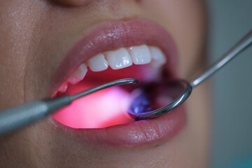 Dental examination with instruments inside mouth