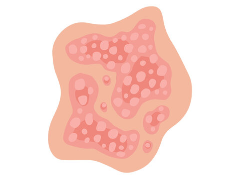 Plaque Psoriasis Disease in Skin
