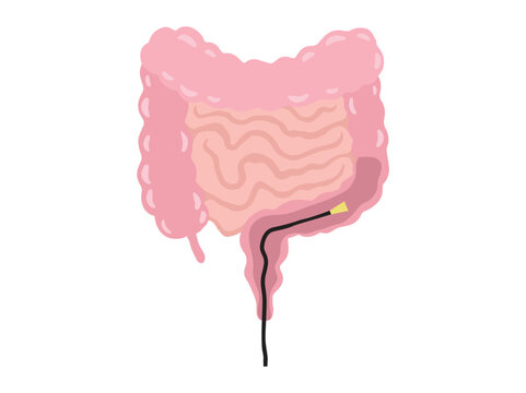 Sigmoidoscopy or Colonoscopy in Intestines
