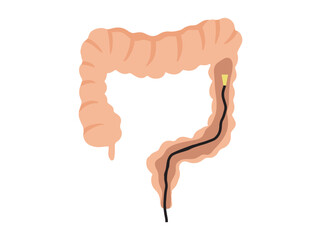 Sigmoidoscopy or Colonoscopy in Intestines

