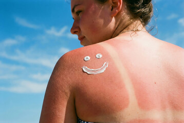 Smiley face symbol drawn with cream on woman red sunburn shoulder