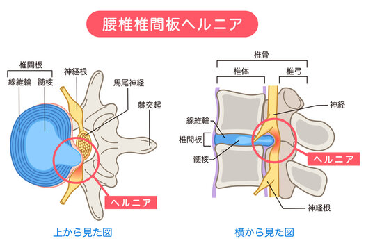 腰椎椎間板ヘルニア　椎間板の構造　腰痛