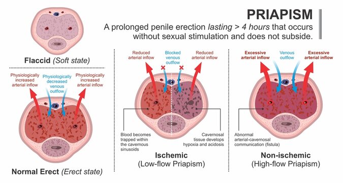 Priapism- Ischemic vs Non-Ischemic