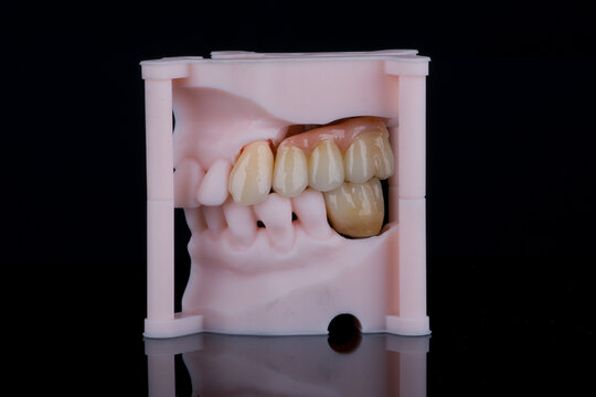 Dental bridge of three teeth made of monolithic zirconia for fixation on implants. Artificial teeth on printed models.