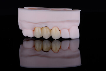 Dental crowns made of zirconium for fixation to upper jaw teeth one of them on titanium abutment © gorynvd