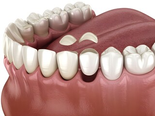 3D Illustration of Dental Veneer Placement on Upper Front Teeth