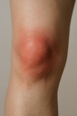 Close up of a human knee showing significant redness and swelling, representing acute inflammation and joint pain for a medical injury concept and healthcare awareness