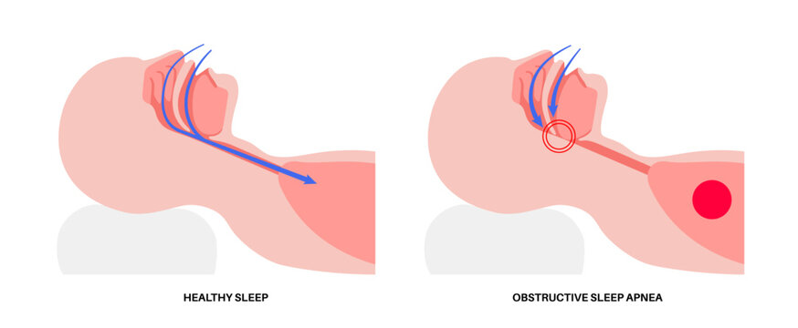 Obstructive sleep apnea