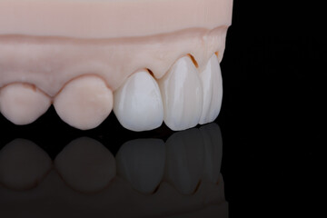 Four dental ultra-thin ceramic veneers in bleach color for fixation to frontal teeth of upper jaw. © gorynvd