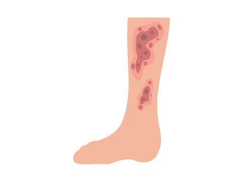 Neurodermatitis Disease in Skin
