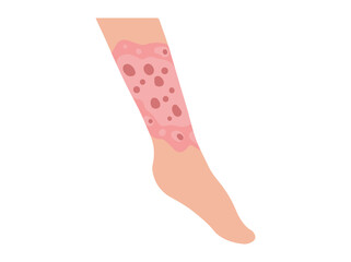 Neurodermatitis Disease in Foot Skin
