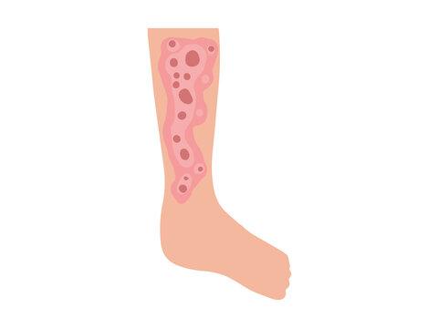 Neurodermatitis Disease in Skin
