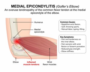 Golfer's Elbow (Medial Epicondylitis) Flashcard