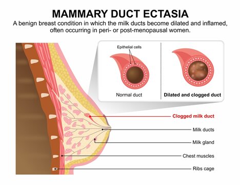 Mammary Duct Ectasia, Breast milk duct inflamed