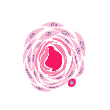 Illustration of squamous cell carcinoma, showing keratin pearl and dyskeratotic cell.