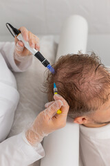 Alopecia. Man hair loss improve growth treatment regeneration, dermapen microneedling, vitamin...