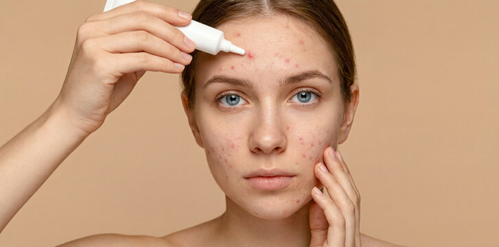 Young woman applying acne cream treatment to pimples on forehead for skincare
