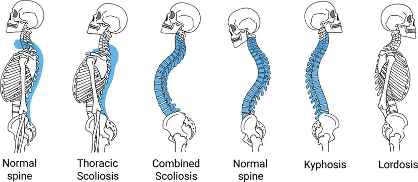 Medical vector illustration showing human spinal curvatures including normal spine thoracic scoliosis combined scoliosis kyphosis and lordosis conditions