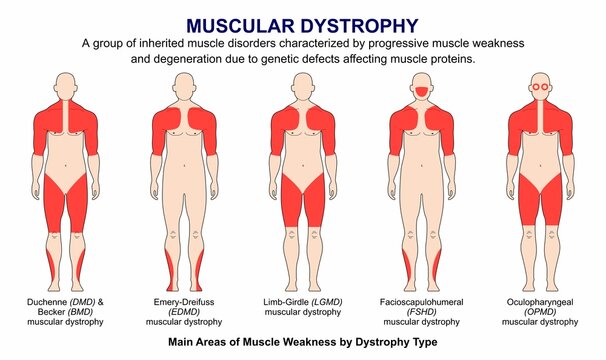 Muscular Dystrophy Types Flashcard Illustration