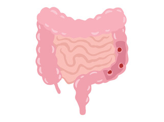 Intestinal Polyps Disease Illustration

